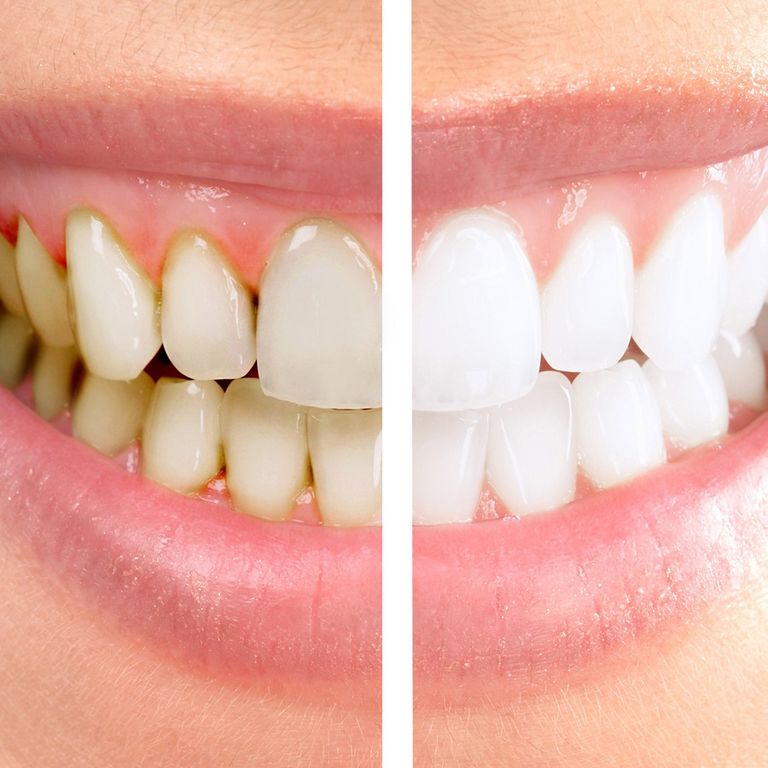 Отбеливание зубов Opalescence Томск Сплавной 1-й отбелить зубы томск цена